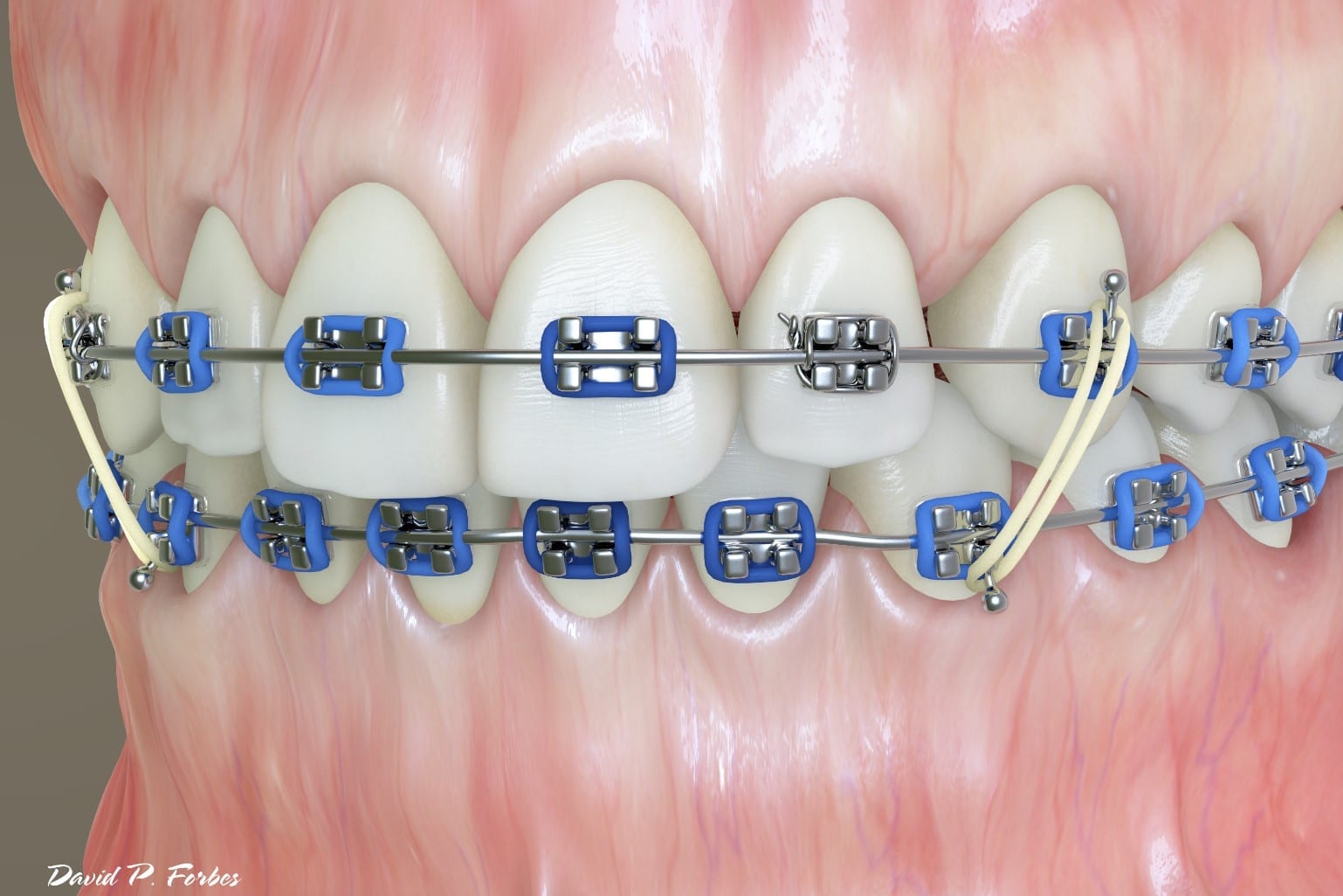 What do the Elastic Rubber Bands on Braces do? - Ask an Orthodontist.com